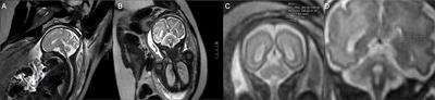 Quantitative Evaluation of a Cross-Sectional Area of the Fetal Straight Sinus by Magnetic Resonance Imaging and Its Clinical Value